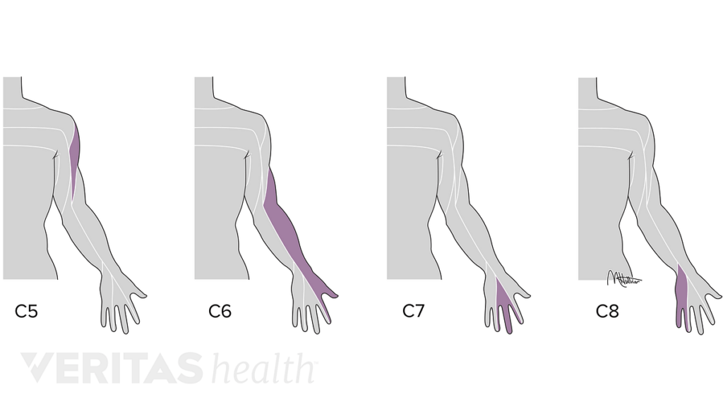 C7 Dermatome Mapneck And Arm Pain Spines Dorset